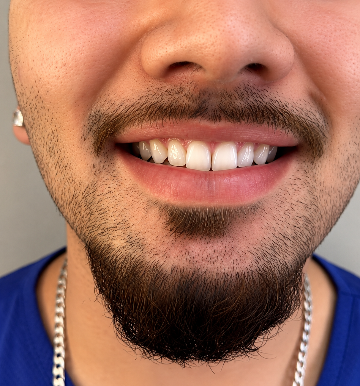 Antes do procedimento com resina